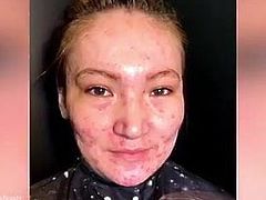 Women with very bad acne